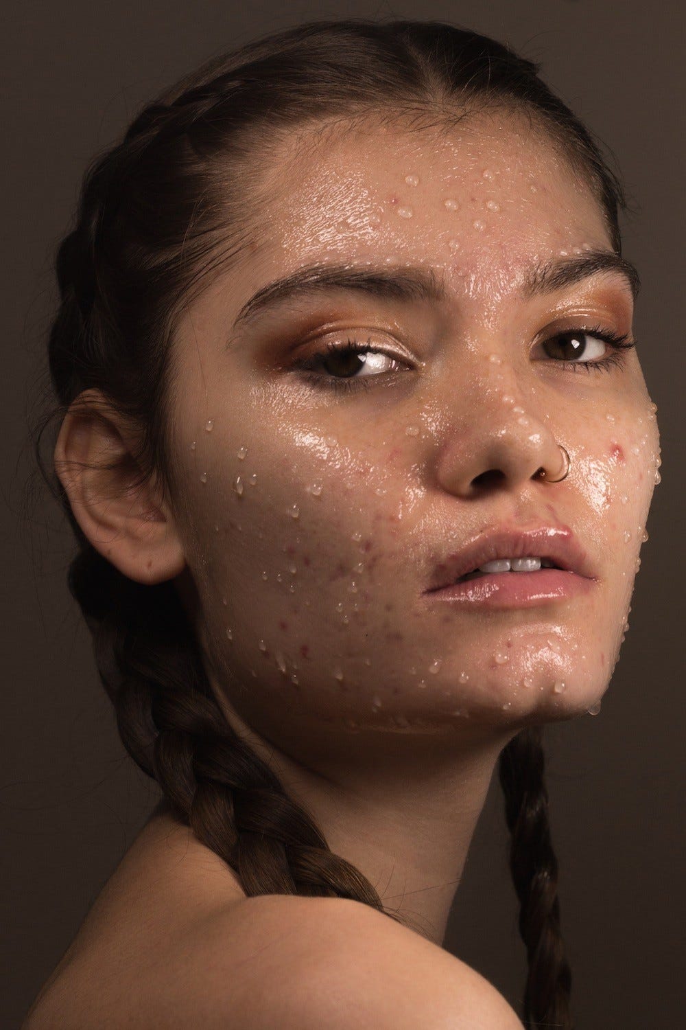 acne betekenis acne betekenis